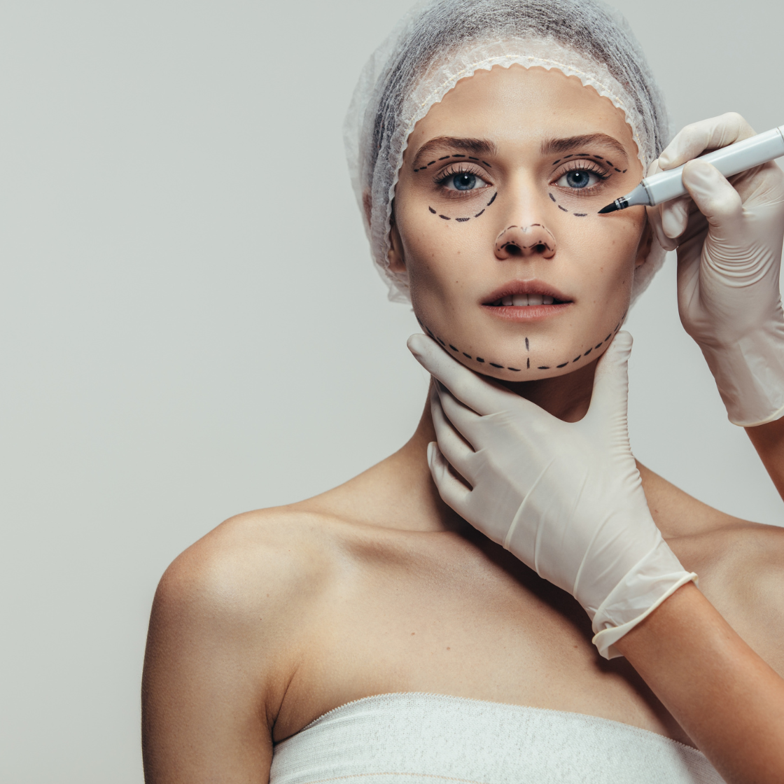 Resultado de lifting facial y de cuello — Dr. Marco Vricella