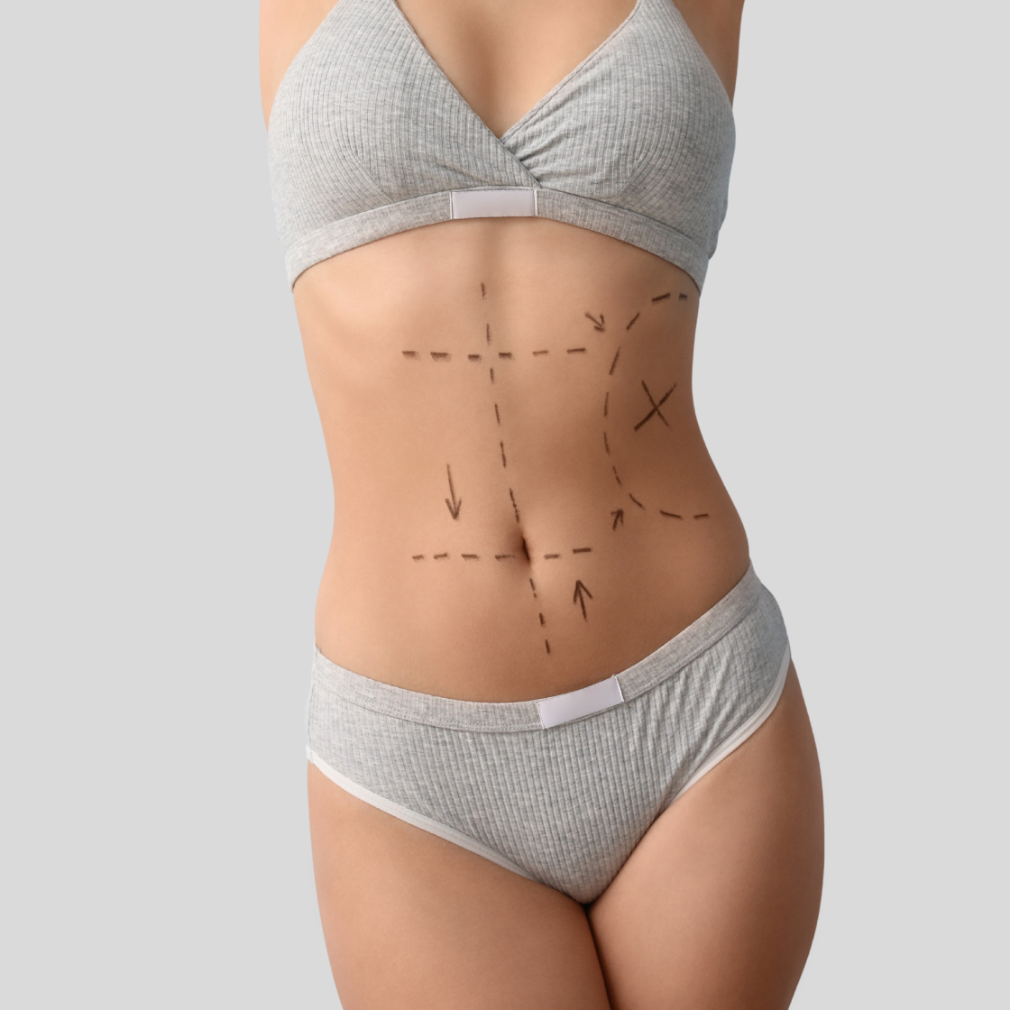 Abdominoplasty result — Dr. Marco Vricella