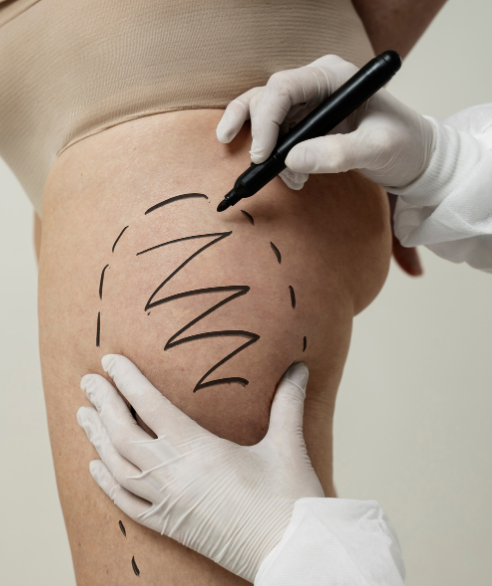 Thigh lift result — Dr. Marco Vricella
