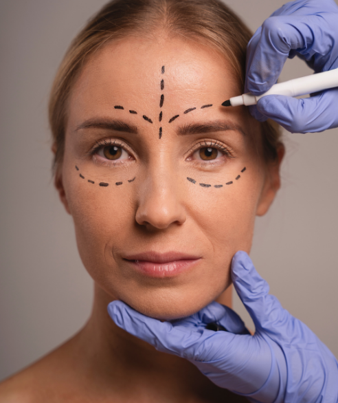 Resultado de blefaroplastia — Dr. Marco Vricella