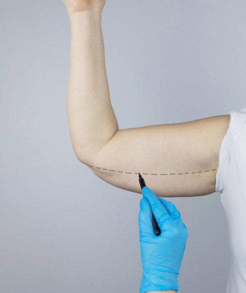Arm lift result — Dr. Marco Vricella