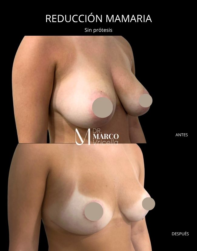 Antes y después — Cirugía de Pecho