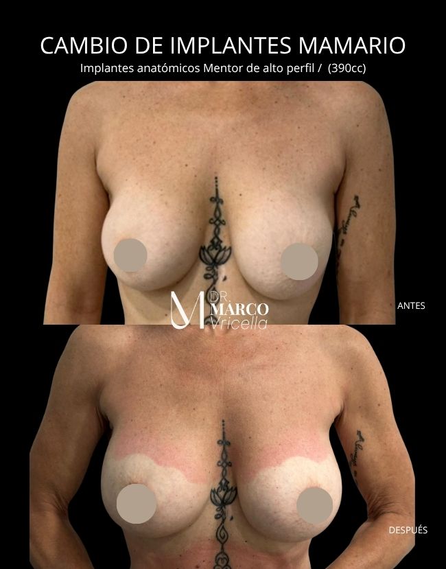Antes y después — Cirugía de Pecho