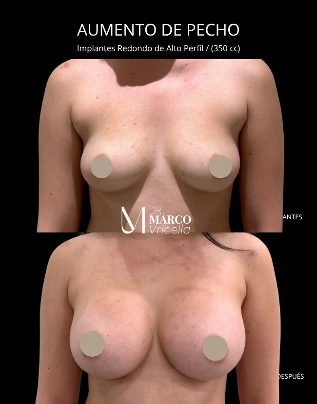 Antes y después — Cirugía de Pecho