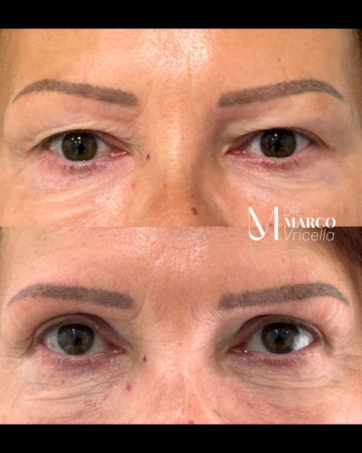 Resultado al año de blefaroplastia superior. Una mirada más descansada, fresca y natural, respetando siempre la esencia de cada paciente. La blefaroplastia superior permite rejuvenecer la mirada eliminando el exceso de piel en los párpados, logrando resultados armónicos y duraderos. _____________________________________________________ One-year upper blepharoplasty result A fresher, more rested, and natural-looking appearance while always preserving each patient’s unique essence. Upper blepharoplasty helps rejuvenate the eyes by removing excess eyelid skin, achieving harmonious and long-lasting results. #Blepharoplasty #FacialRejuvenation #EyelidSurgery #madrid marbella drvricella #blefaroplastia