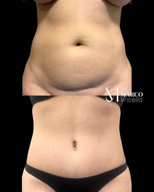 Abdominoplastia Una cicatriz diseñada para quedar perfectamente escondida bajo un bikini. Resultado a tan solo 2 meses de cirugía, mostrando un abdomen más firme, definido y armónico. ____________________________________________________ Tummy Tuck A scar carefully designed to remain perfectly hidden under a bikini. Results only 2 months after surgery, revealing a firmer, flatter, and more contoured abdomen. #Miniabdominoplastia #CirugíaEstética #vricella #madrid #ResultadosNaturales