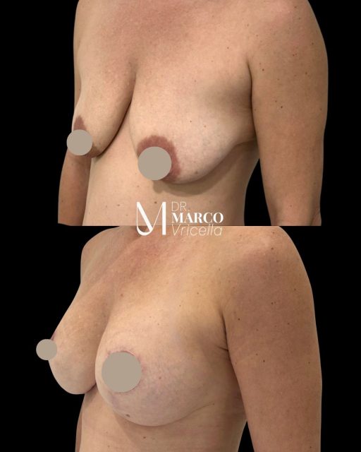 Mastopexia de aumento utilizando implantes redondos perfil medio de 290cc Un resultado que combina proyección, armonía y una forma natural, respetando siempre la anatomía de cada paciente. Resultado al año de cirugía, mostrando una evolución estable y completamente adaptada. #drmarcovricella #marbella #madrid #mastopexia #implants
