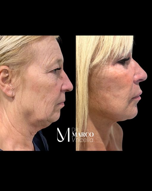 Lifting de Cara y Cuello + Blefaroplastia Completa Rejuvenecimiento facial integral para una apariencia más fresca, firme y natural. • Rostro más definido • Cuello rejuvenecido • Mirada descansada • Resultados naturales ___________________________________________________ Facelift & Neck Lift with Full Blepharoplasty Comprehensive facial rejuvenation for a fresher, firmer, and more youthful appearance. • More defined facial contours • Rejuvenated neck • Refreshed eyes • Natural-looking results #DrMarcoVricella #LiftingFacial #LiftingDeCuello #Blefaroplastia #lifting