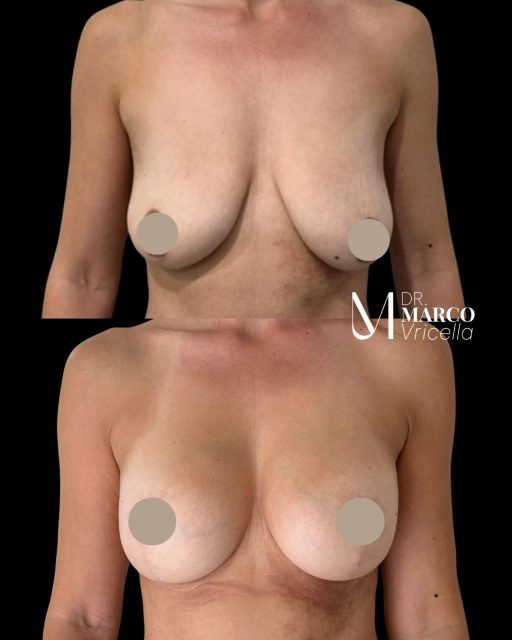 Breast lift with augmentation using 265 cc medium-profile round implants. One-year result: enhanced shape, natural projection, and beautifully balanced contours. #drmarcovricella #madrid #marbella #gibratar #mastopexia