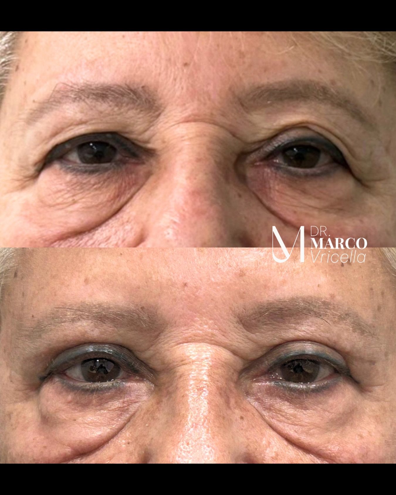 Blefaroplastia superior | Resultados a los 6 meses Una mirada más descansada, fresca y rejuvenecida, manteniendo siempre la naturalidad de cada paciente. A los 6 meses, la inflamación ha desaparecido prácticamente por completo y las cicatrices continúan madurando, permitiendo apreciar el resultado definitivo de la cirugía. #Blepharoplasty #madrid #marbella #drvricella #blefaroplastia