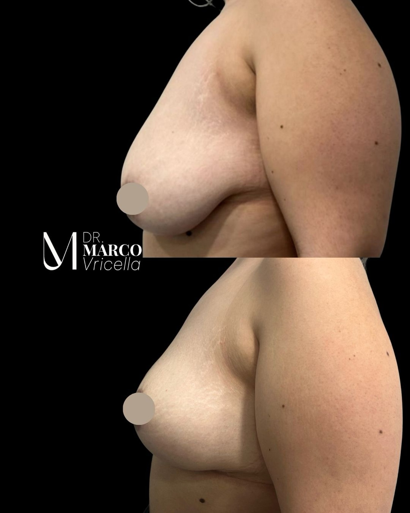 Mastopexia sin implantes | Resultado a los 3 meses La mastopexia permite reposicionar y remodelar la mama, restaurando su forma y proyección sin necesidad de utilizar implantes cuando existe volumen mamario suficiente. En este caso, a los 3 meses de la intervención, observamos una mejora en la posición, la simetría y el contorno mamario, manteniendo un resultado natural y acorde con la anatomía de la paciente. La correcta indicación quirúrgica y una planificación individualizada son fundamentales para obtener resultados estéticos duraderos y armónicos. #drmarcovricella #madrid #marbella #gibratar #mastopexia
