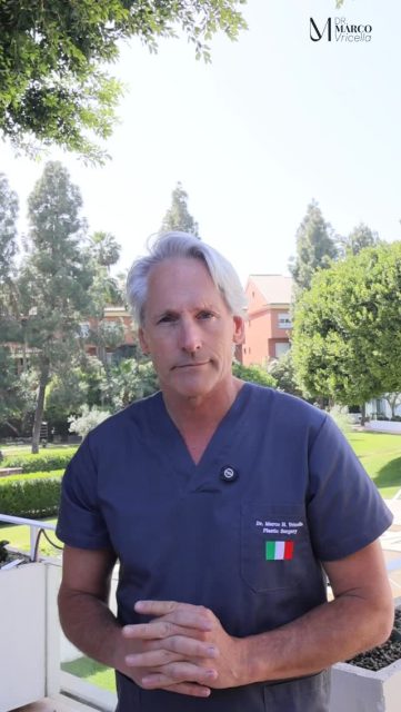 Hoy te cuento el caso de mi paciente. Apenas 10 días después de una cirugía de lifting facial y cervical, ya podemos apreciar una transformación increíble. A pesar de que todavía existe inflamación propia del postoperatorio, el rostro se ve más definido, el cuello más firme y el óvalo facial mucho más rejuvenecido. Uno de los aspectos que más valoro en mis resultados es mantener la naturalidad. El objetivo de un lifting no es cambiar tu rostro, sino devolverte una versión más fresca, descansada y armónica de ti mismo. Y lo mejor es que el resultado seguirá mejorando durante los próximos meses. Resultado a los 10 días de la cirugía. #liftingfacial #marbella #marcovricella #lifting #madrid