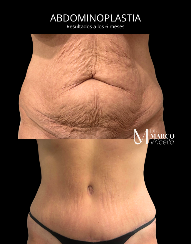 Before and after — Abdominoplasty