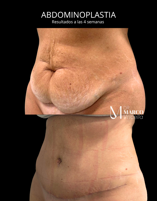 Before and after — Abdominoplasty