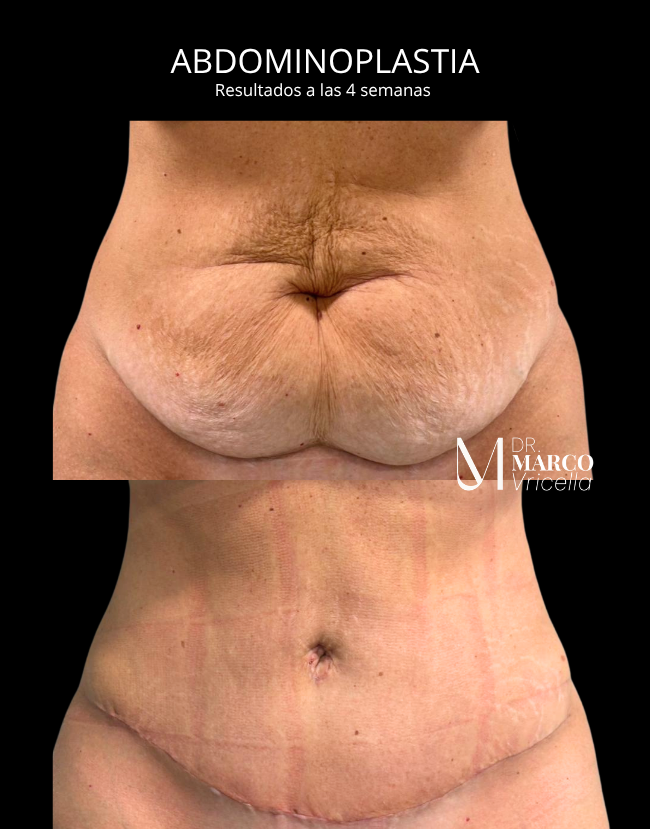 Before and after — Abdominoplasty