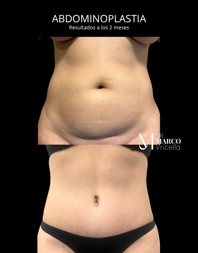 Before and after — Abdominoplasty