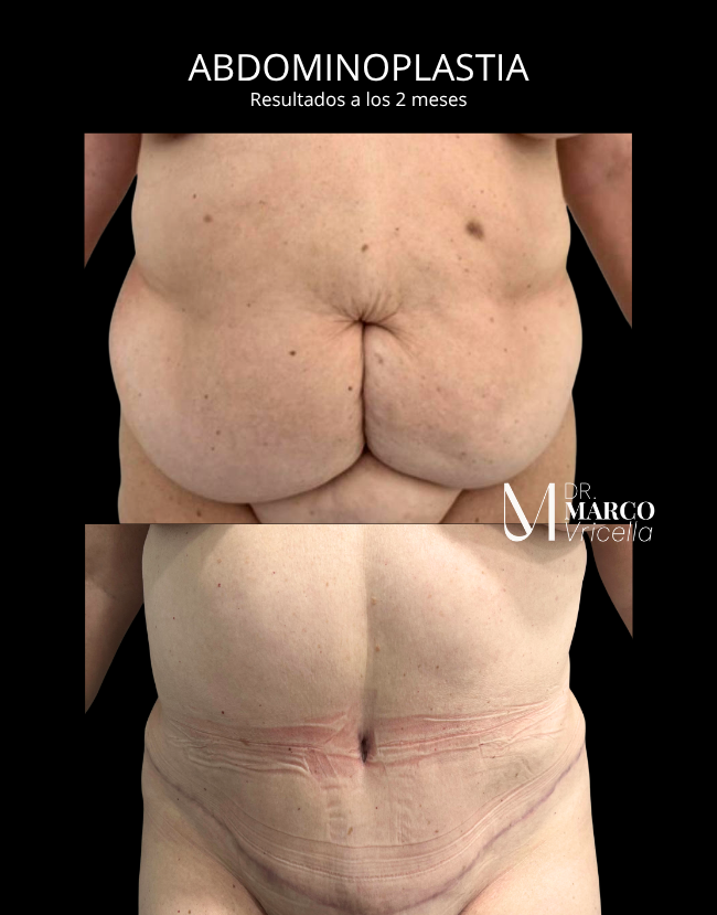 Before and after — Abdominoplasty